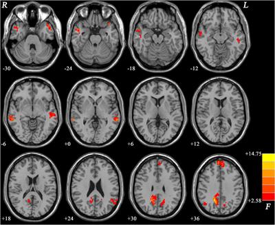 Abnormal Default Mode Network Homogeneity in Major Depressive Disorder With Gastrointestinal Symptoms at Rest